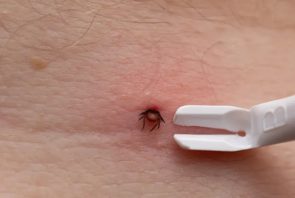 Kleszcz - Jak usunąć, co obserwować i kiedy do lekarza?