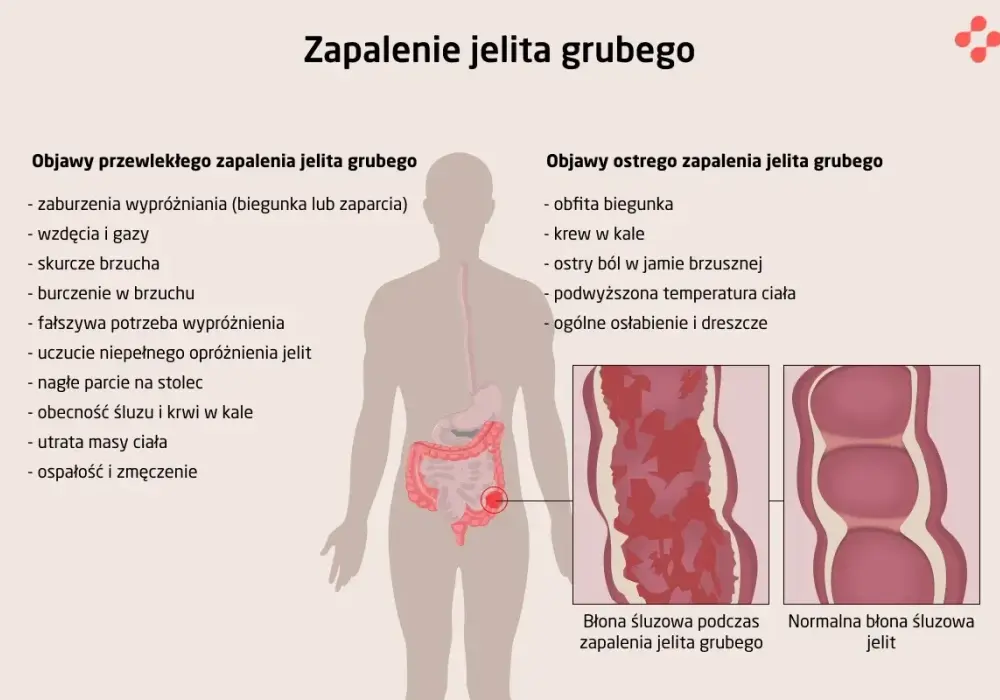 Zapalenie jelit - co naprawdę działa? Uniknij błędów!