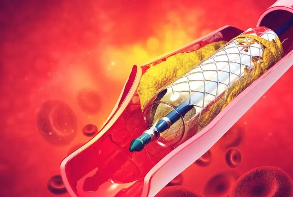 Stent - kiedy warto? Zabieg, rekonwalescencja i życie po