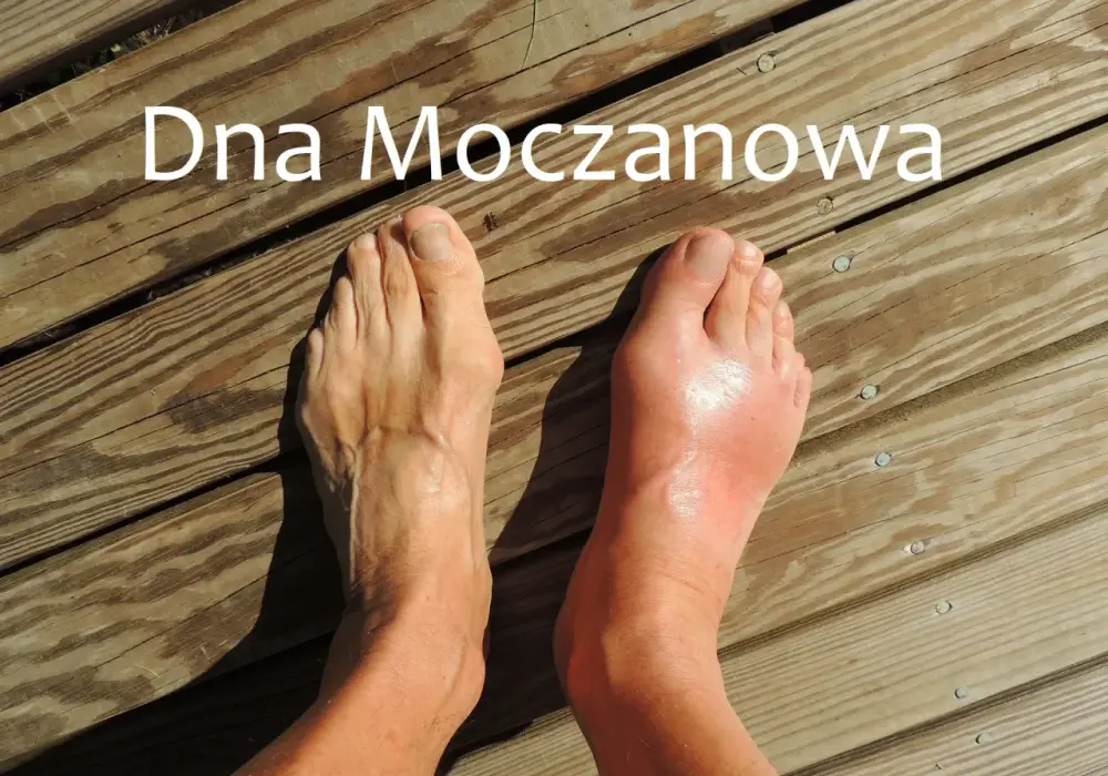Dna moczanowa stopy - Jak rozpoznać atak i co robić?