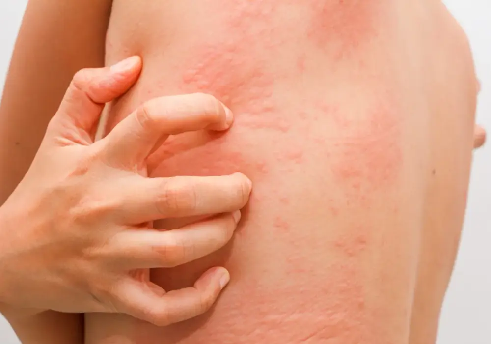 Salicylany - Nadwrażliwość? Rozpoznaj i ogranicz rozsądnie
