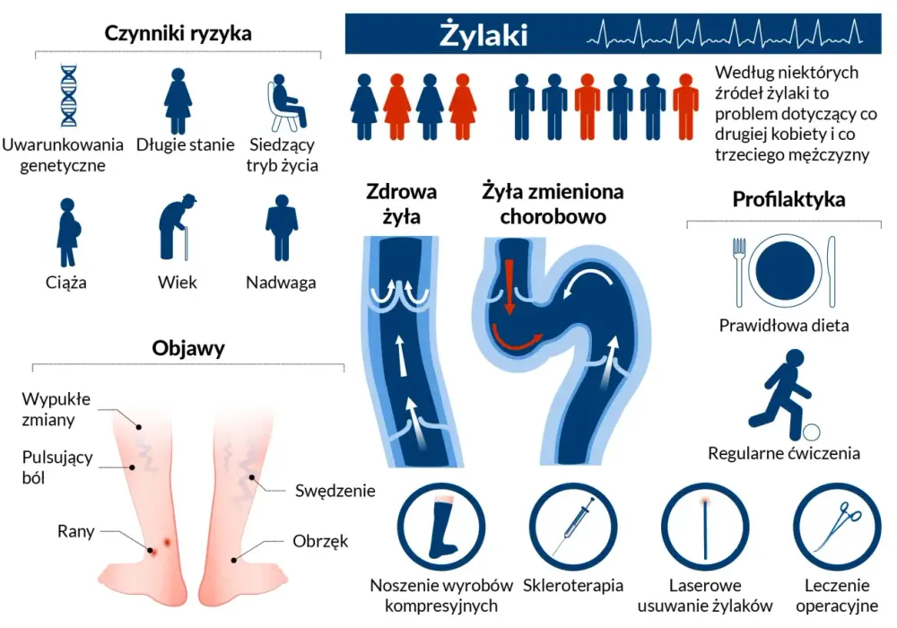 Żylaki - Operacja czy nie? Jak wybrać metodę i nie żałować