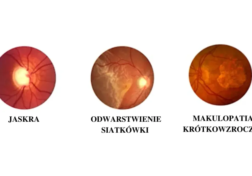 Krótkowzroczność - Rozpoznaj, koryguj i spowolnij progresję!