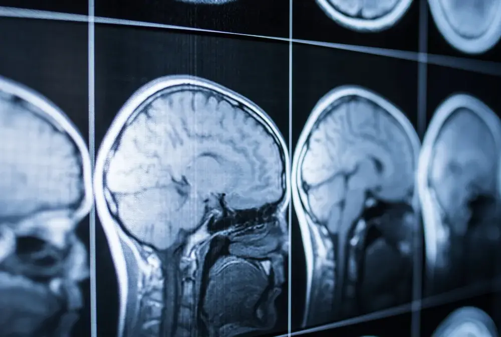 Śmierć mózgu - Diagnoza i skutki. Rozwiej wątpliwości