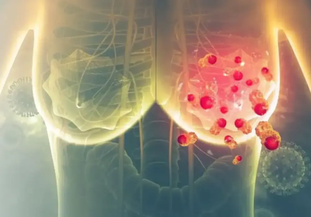 Trastuzumab - terapia celowana. Co musisz wiedzieć?