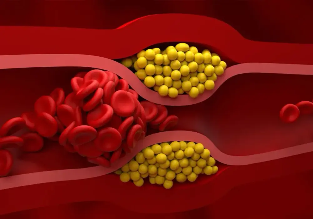 Cholesterol nie-HDL - interpretacja i co robić, gdy jest za wysoki