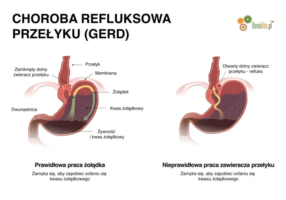 Co na refluks żołądka? Sposoby na zgagę i nocne objawy