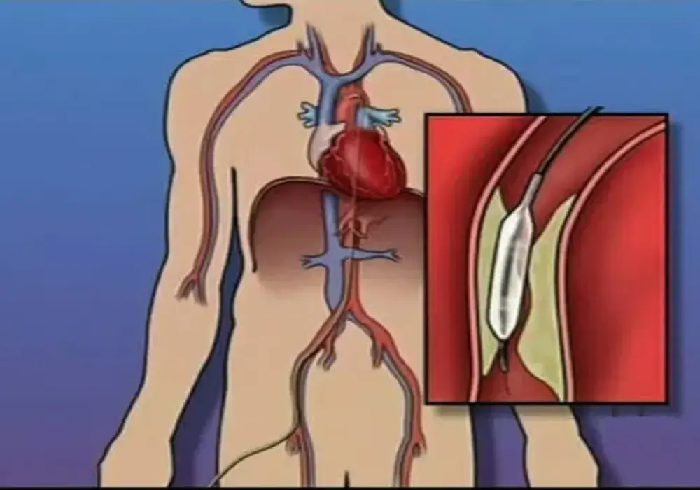 Angioplastyka i stent: Jak utrzymać drożność tętnic?