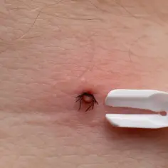 Usuwanie kleszcza z ludzkiej skóry za pomocą specjalnych szczypiec. Widoczny jest ukąszenie kleszcza i narzędzie do jego usunięcia.