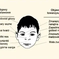 Ilustracja twarzy dziecka z zaznaczonymi cechami fizycznymi, takimi jak mały obwód głowy, płaska twarz i wąska górna warga.