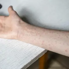 Ręka i przedramię pokryte drobnymi, czerwonymi plamkami, objawem odry u dorosłych.