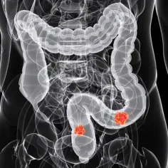 Przedstawienie anatomiczne jelita grubego z zaznaczonymi dwoma zmianami: gruczolak cewkowy z dysplazją małego stopnia.