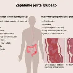 Objawy zapalenia jelita grubego: biegunka, krew w kale, ból brzucha, gorączka, osłabienie. Ilustracja pokazuje chore jelito.
