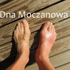 Dna moczanowa stopy: opuchnięty, czerwony paluch i kostka po prawej, zdrowa stopa po lewej.
