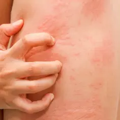 Swędząca wysypka na plecach, być może reakcja na salicylany. Dłoń drapie zaczerwienioną skórę.
