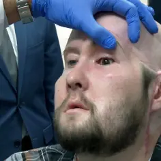 Lekarz w niebieskiej rękawiczce delikatnie podnosi powiekę pacjenta, który przeszedł przeszczep oka. Widoczne blizny po operacji.