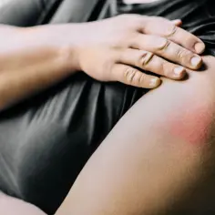 Ramię z zaczerwienieniem i obrzękiem, objawy odczynu poszczepiennego. Dłoń dotyka bolącego miejsca.