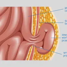 Anatomia przepukliny pachwinowej: jelito cienkie w worku przepuklinowym. Jak długo można chodzić z przepukliną pachwinową?