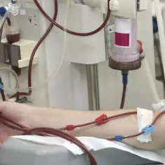 Ręka pacjenta podłączona do aparatury do dializy nerek. Czerwone wężyki prowadzą krew do i z maszyny, która oczyszcza ją.