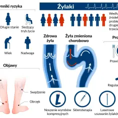 Grafika przedstawia żylaki, ich objawy, czynniki ryzyka i metody leczenia, w tym operację żylaków.