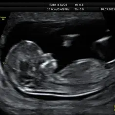 Pierwsze badanie prenatalne dopochwowo czy przez brzuch - co wybrać?