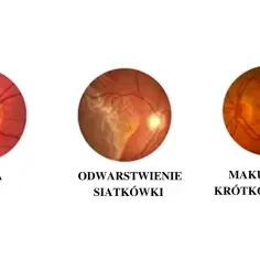 Trzy obrazy dna oka: jaskra, odwarstwienie siatkówki i makulopatia krótkowzroczna.