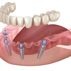Proteza na 2 implantach cena. Górna proteza zębowa wsparta na czterech implantach, dolna proteza na dwóch implantach.