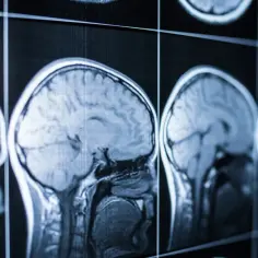 Przekroje mózgu na ekranie, niektóre wyraźne, inne rozmyte. Obraz sugeruje diagnozę śmierci mózgowej.