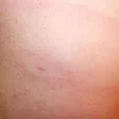 Skóra z drobnymi kropkami i zaczerwienieniem, sugerujące odczyn alergiczny po kleszczu.