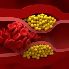 Zator w naczyniu krwionośnym: czerwone krwinki i żółte złogi cholesterolu. Nie HDL to zły cholesterol.