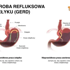Ilustracja pokazuje prawidłowe i nieprawidłowe działanie zwieracza przełyku, wyjaśniając co na refluks żołądka.