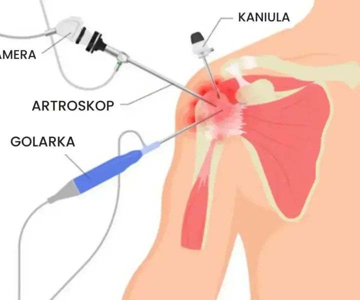 Artroskopia barku NFZ gdzie najszybciej? Sprawdź najlepsze miejsca