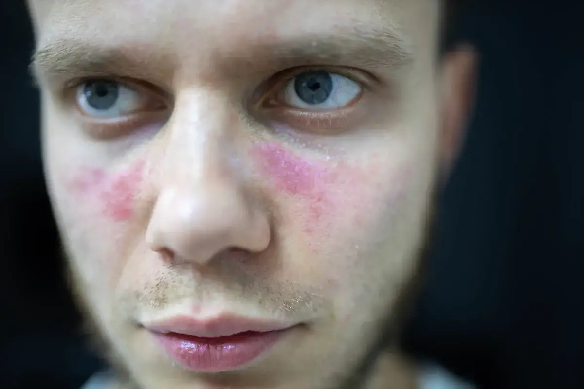 Oczy mężczyzny z rumieńcem na policzkach, przypominającym motyla. Czy toczeń ile się żyje?