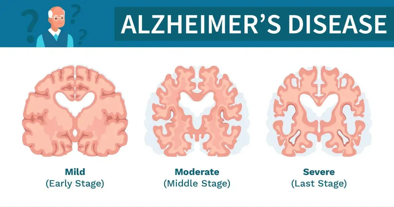 Trzy przekroje mózgu pokazujące postęp choroby Alzheimera: łagodny, umiarkowany i ciężki. Jak długo alzheimer ile się żyje?