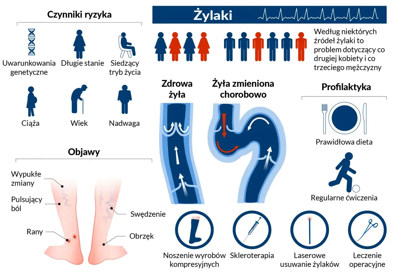 Grafika przedstawia żylaki, ich objawy, czynniki ryzyka i metody leczenia, w tym operacyjne usuwanie żylaków.