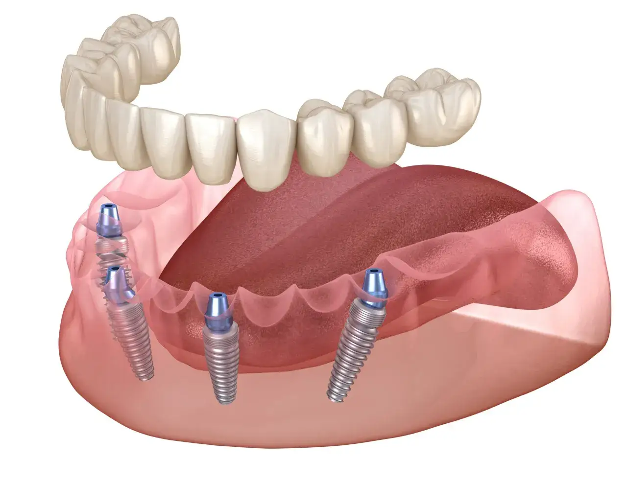 Proteza na 2 implantach cena. Górna szczęka z zębami, dolna szczęka z implantami i językiem.