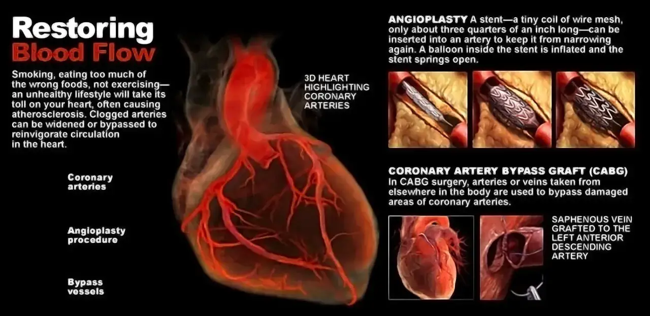 Obraz przedstawia serce z widocznymi tętnicami wieńcowymi, ilustrując metody rewaskularyzacji: angioplastykę i CABG.