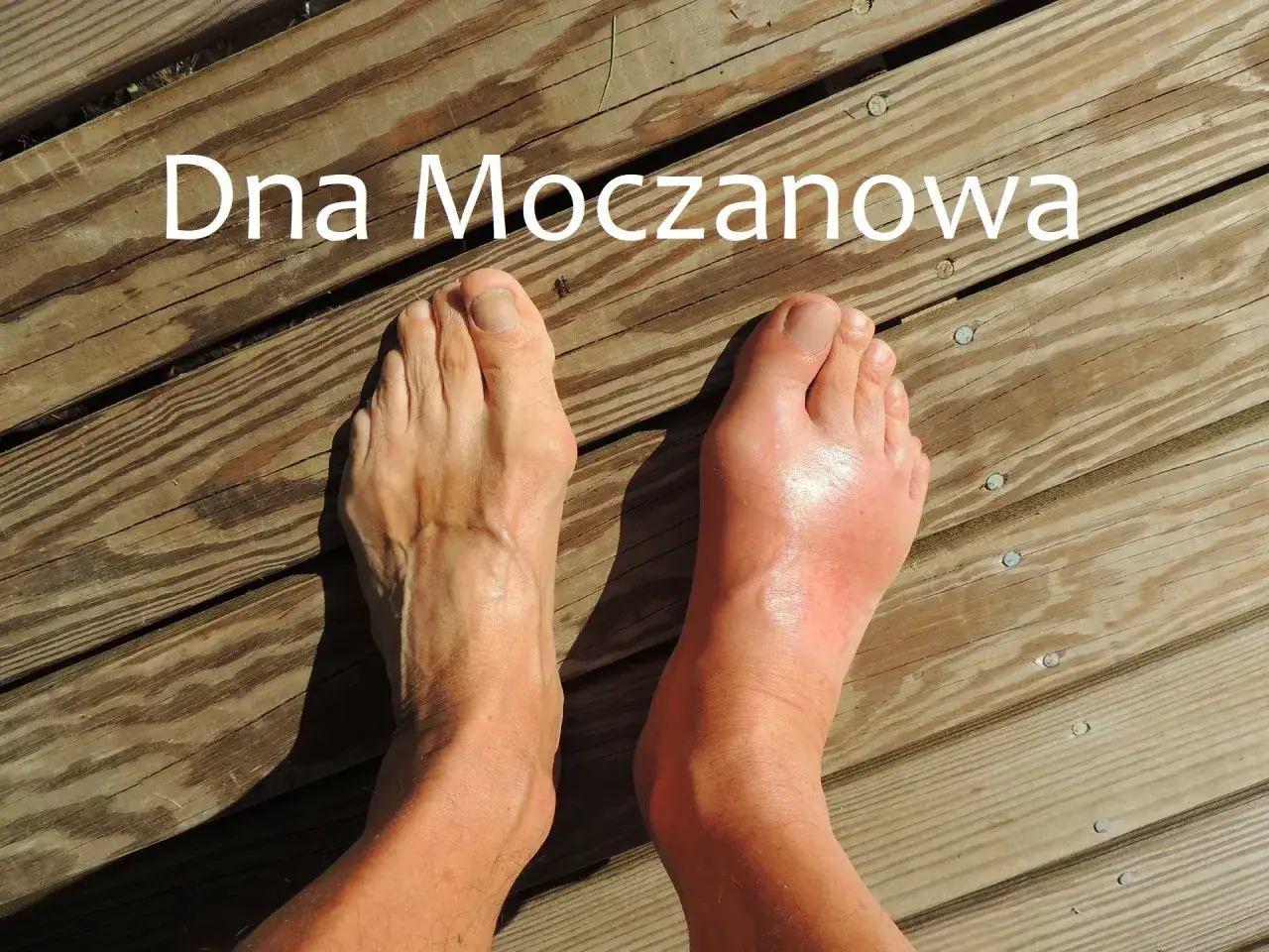 Dna moczanowa stopy: opuchnięty, zaczerwieniony prawy staw skokowy kontrastuje ze zdrową lewą stopą.