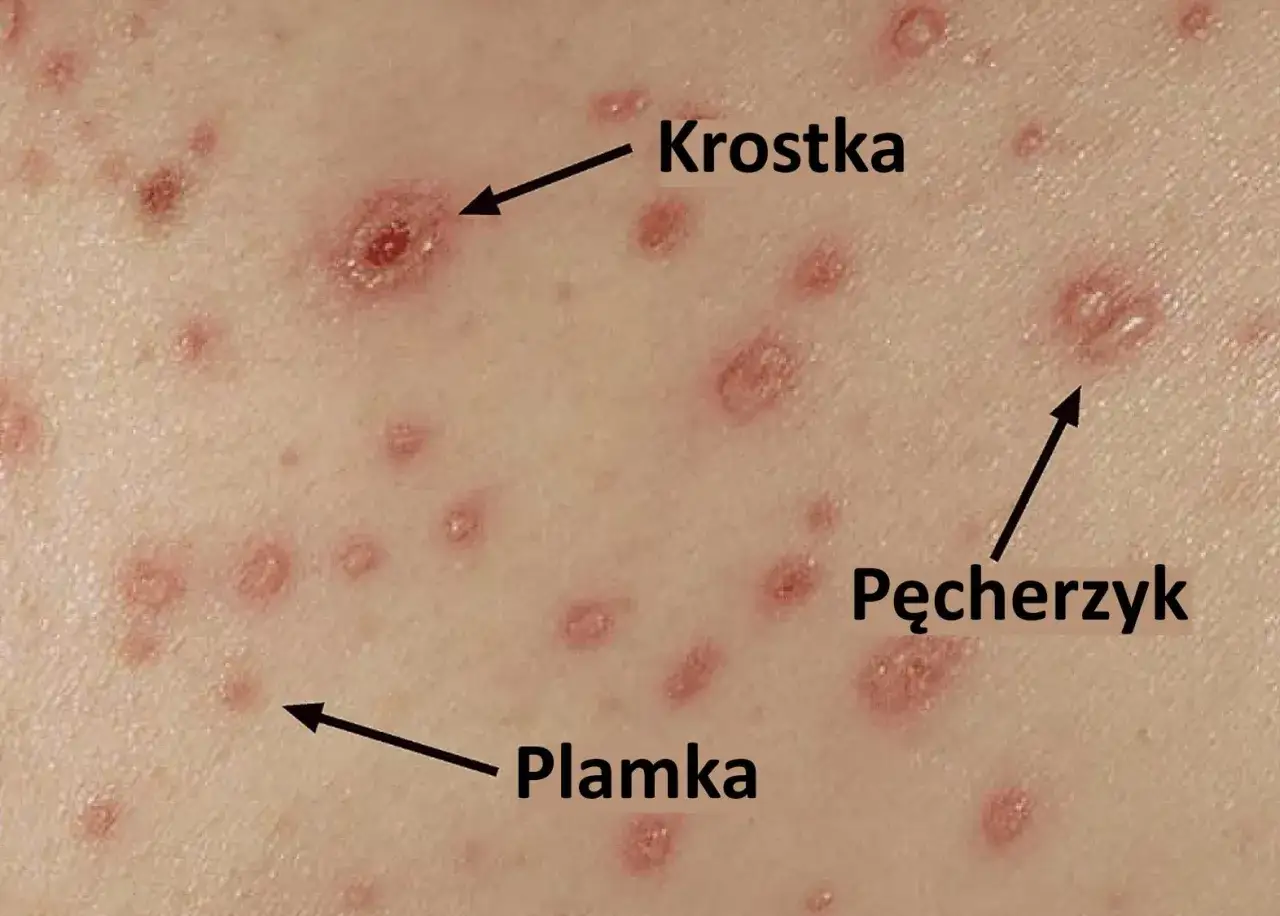 Zmiany skórne charakterystyczne dla ospy prawdziwej: plamki, krostki i pęcherzyki.