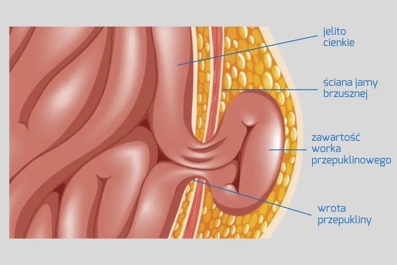 Anatomia przepukliny pachwinowej: jelito cienkie uwypukla się przez ścianę jamy brzusznej. Jak długo można chodzić z przepukliną pachwinową?