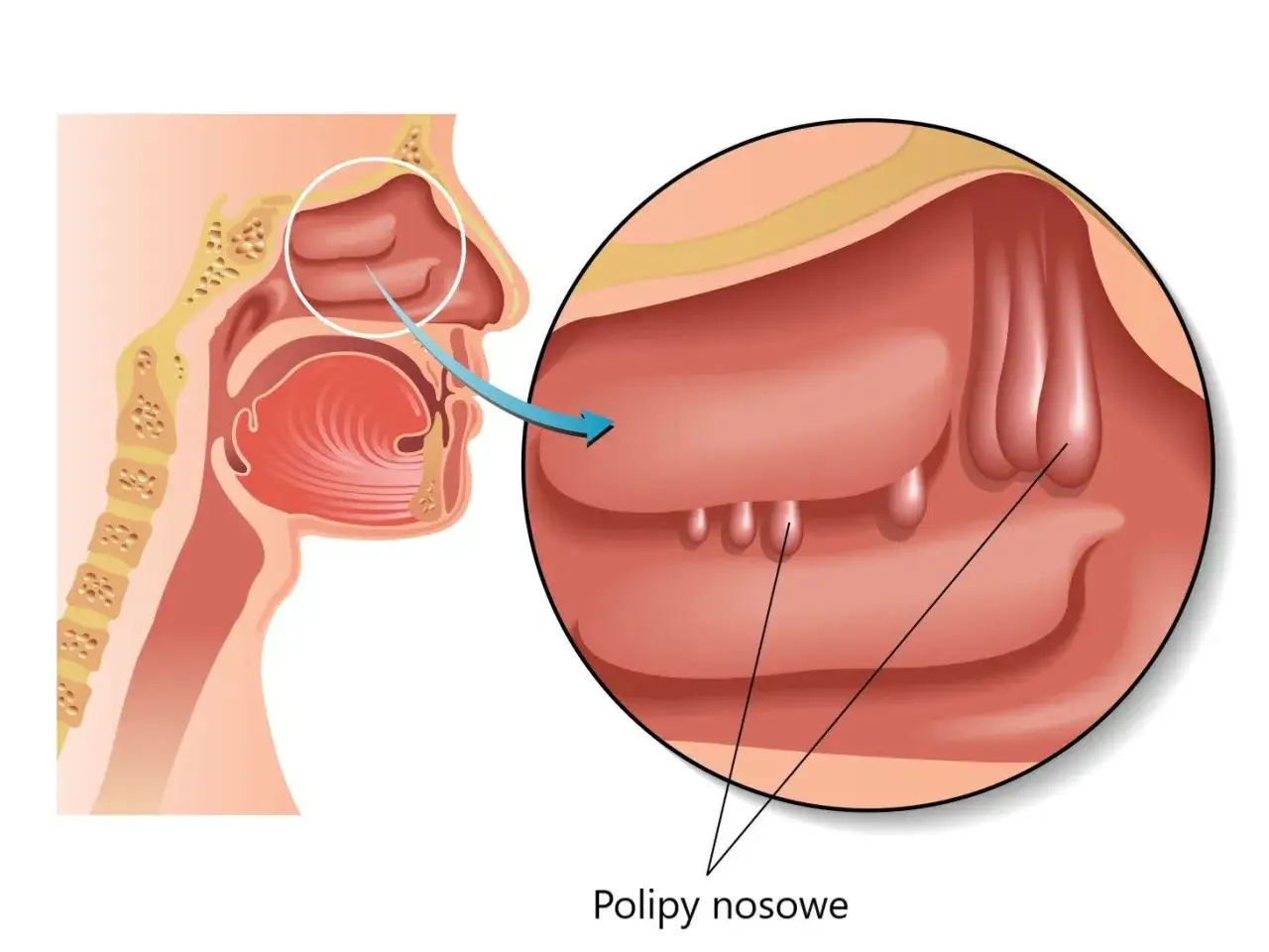 Przekrój nosa z widocznymi polipami nosowymi. Powiększony fragment ukazuje łagodne narośla w jamie nosowej.