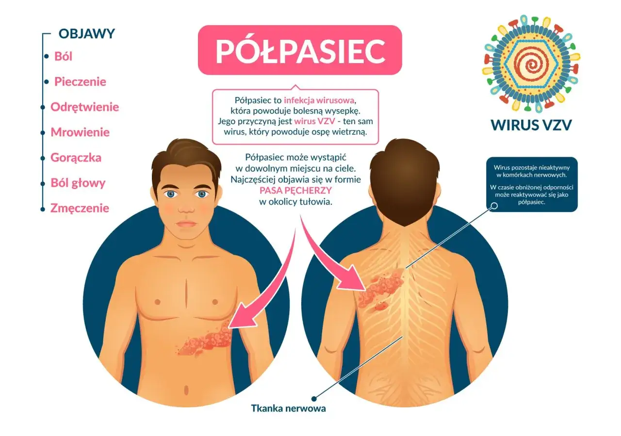 Półpasiec, wywoływany przez wirus VZV, objawia się bolesną wysypką. Czy półpasiec jest groźny? Może wystąpić w dowolnym miejscu, często jako pas pęcherzy.