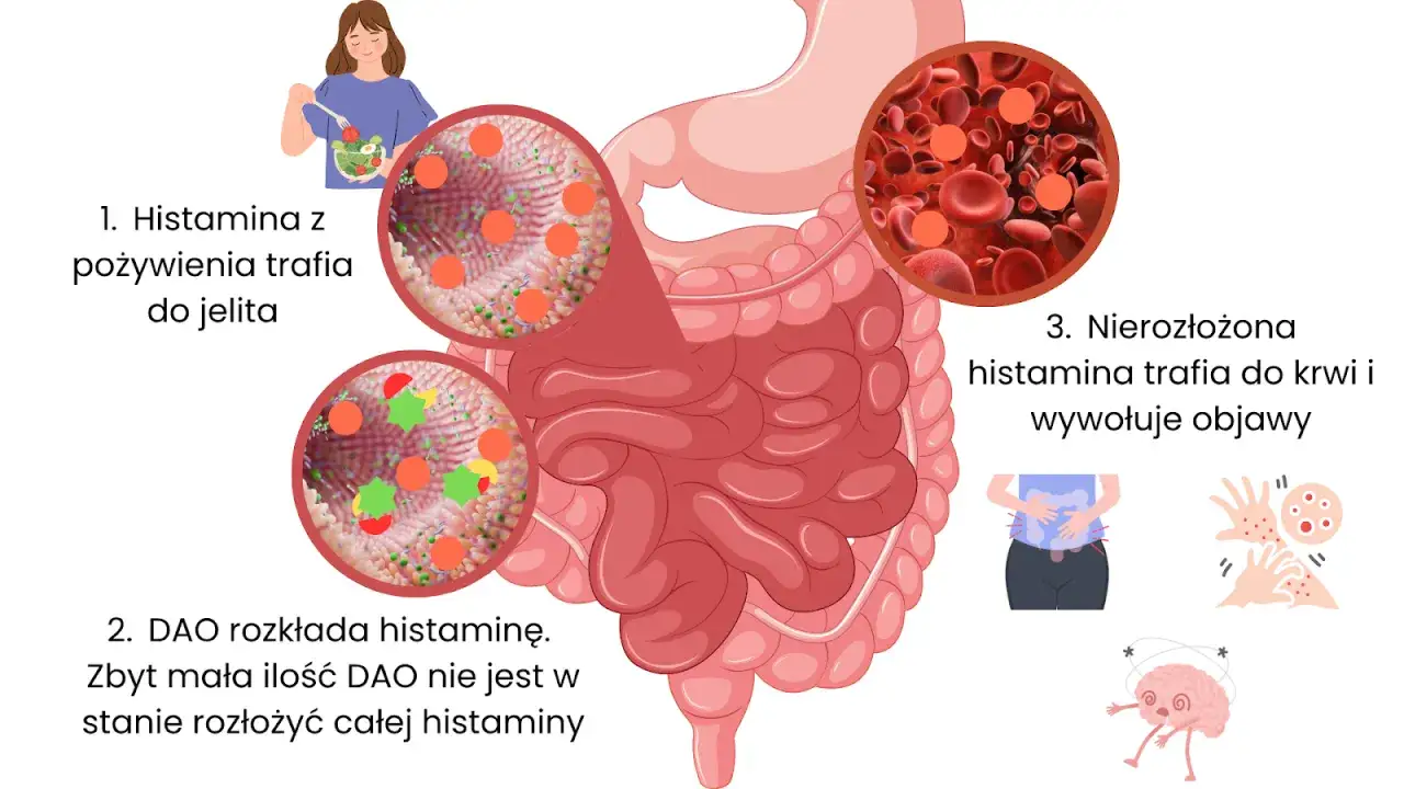 Ilustracja wyjaśnia nietolerancję histaminy: histamina z jedzenia trafia do jelita, gdzie DAO próbuje ją rozłożyć. Nierozłożona histamina powoduje objawy.