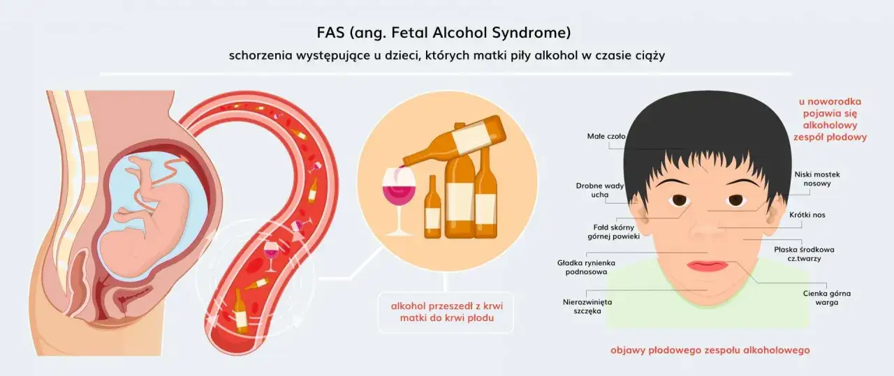 Ilustracja pokazuje płód w łonie matki, butelki alkoholu i twarz dziecka z cechami FAS. Alkohol przechodzi z krwi matki do krwi płodu, powodując znane osoby z FAS.
