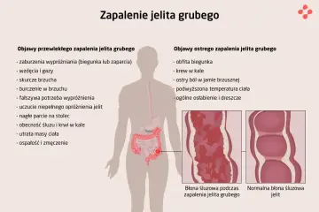 Ilustracja przedstawia objawy zapalenia jelita grubego, w tym bóle brzucha i krew w kale, porównując stan zapalny z normalną błoną śluzową jelit.