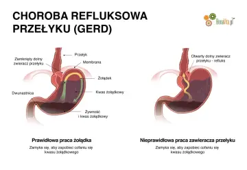 Ilustracja pokazuje prawidłowe i nieprawidłowe działanie zwieracza przełyku, wyjaśniając co na refluks żołądka.