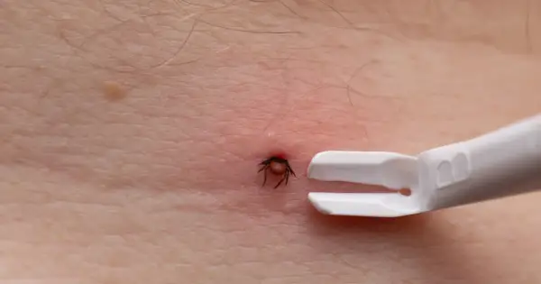 Kleszcz - Jak usunąć, co obserwować i kiedy do lekarza?
