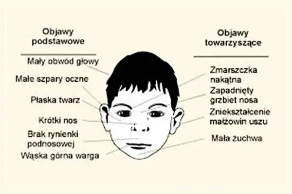 Znane osoby z FAS - Kto naprawdę ma diagnozę?