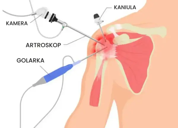 Artroskopia barku NFZ gdzie najszybciej? Sprawdź najlepsze miejsca