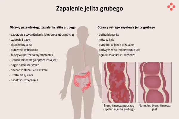 Wrzodziejące zapalenie jelita grubego - objawy i leczenie